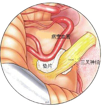 三叉神经痛和继发性的三叉神经痛,三叉神经贴治疗三叉神经痛的原理
