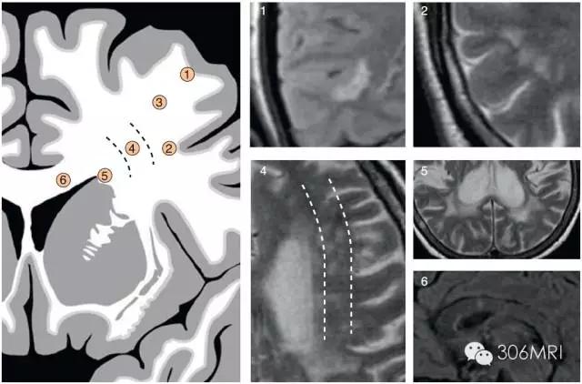 核磁共振轻度脑白质征象,脑白质内见多发斑点什么状况