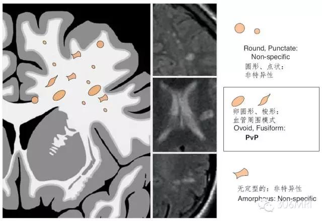 核磁共振轻度脑白质征象,脑白质内见多发斑点什么状况