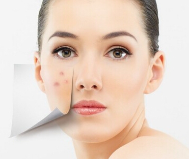 长痘痘太影响气质了,长痘痘影响美观怎么办