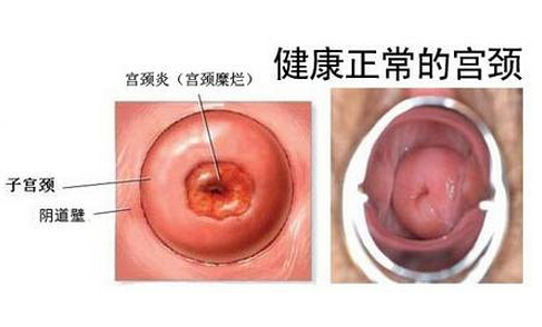 女性宫颈炎会导致出血吗,女的宫颈炎