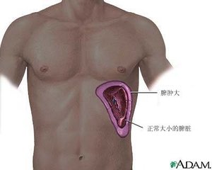 如果把脾脏切了以后会注意什么,脾脏大一定要切吗