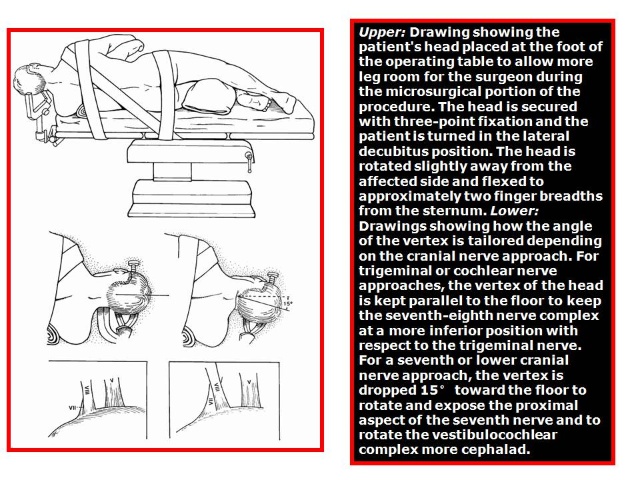 三叉神经痛和继发性的三叉神经痛,三叉神经贴治疗三叉神经痛的原理