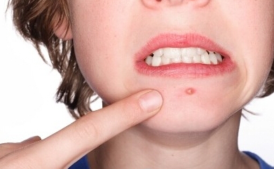 长痘痘太影响气质了,长痘痘影响美观怎么办