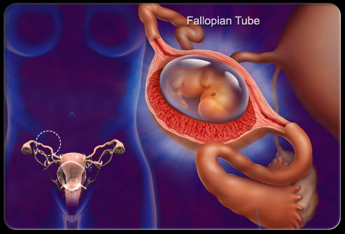 盆腔疼痛怎么引起的,盆腔疼痛是什么原因引起的