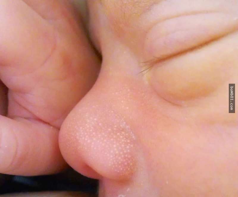 能去脸部小肉球的药膏,面部小肉球怎么去除简单方法