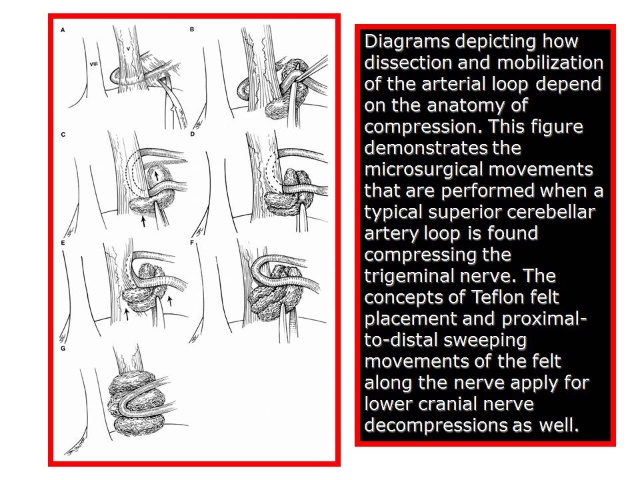 三叉神经痛和继发性的三叉神经痛,三叉神经贴治疗三叉神经痛的原理