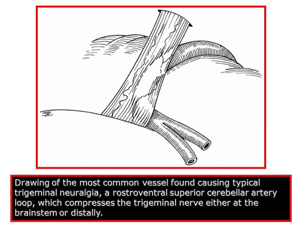 三叉神经痛和继发性的三叉神经痛,三叉神经贴治疗三叉神经痛的原理