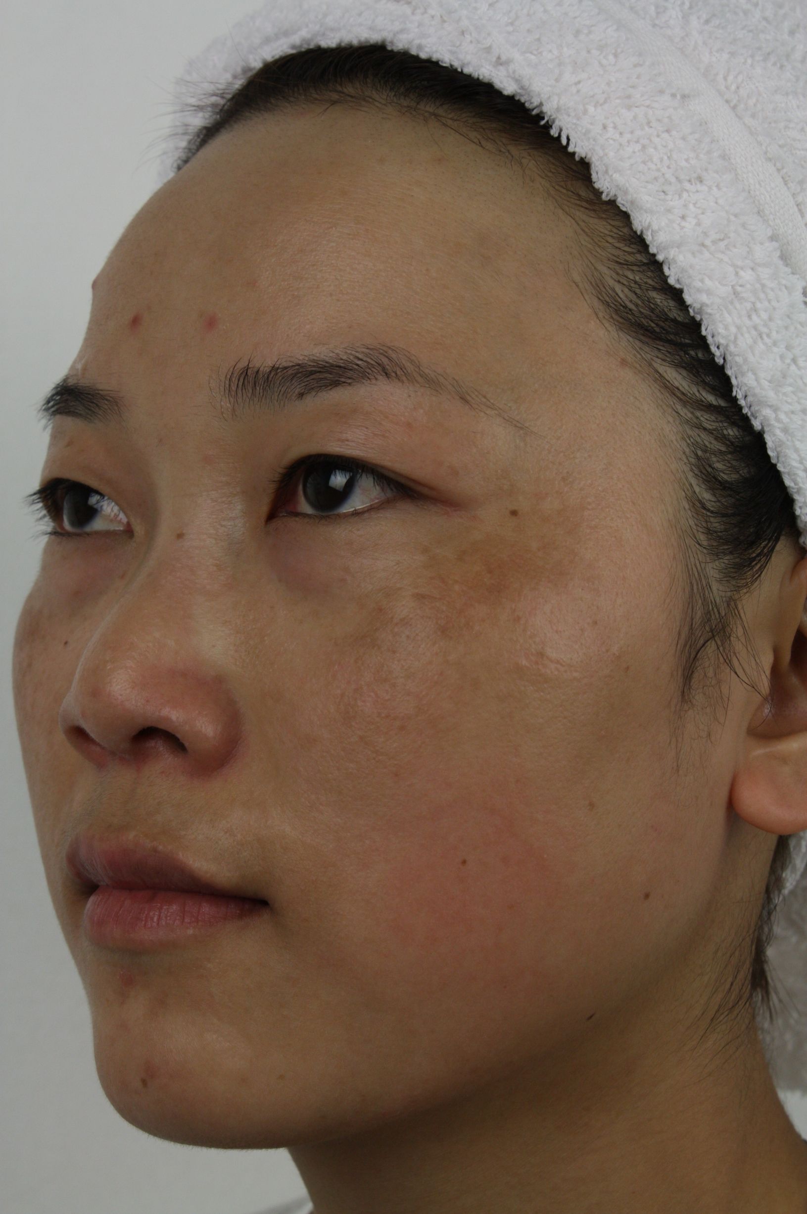 淡化斑点的方案,怎样抑制或淡化斑点