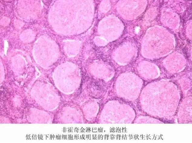 非霍奇金淋巴瘤靶向药价格表,非霍奇金淋巴瘤寿命为多久
