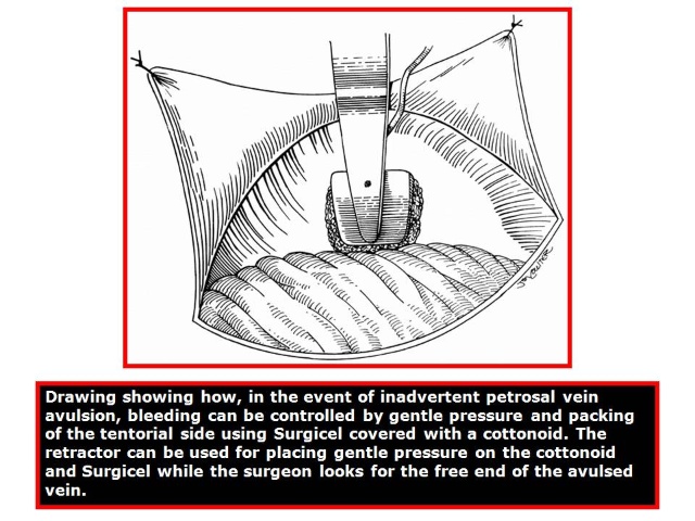 三叉神经痛和继发性的三叉神经痛,三叉神经贴治疗三叉神经痛的原理