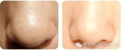 这个妈妈是这样用五毛钱的苏打去黑头的,膜拜!