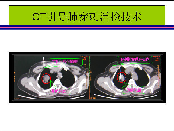 发现肺部有结节怎么可能不焦虑,查出肺部肿块怎么办