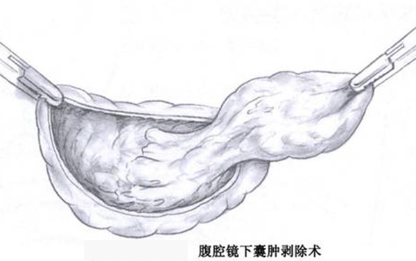 关于卵巢肿物——你必须关注的四大问题