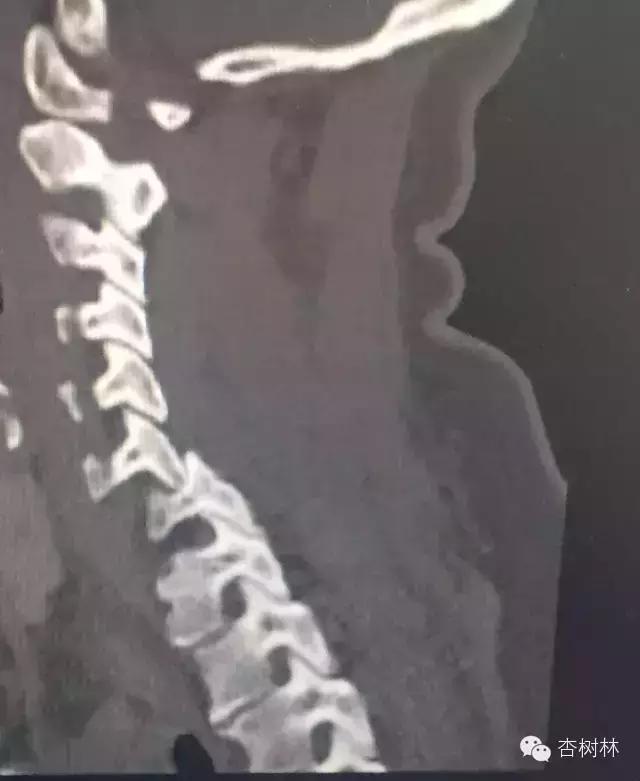 脊椎脱位是啥意思,脊椎脱位怎么牵引