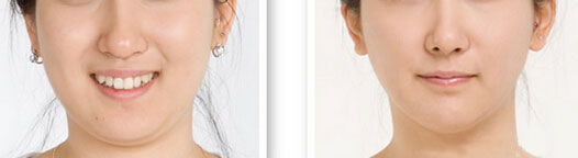 双下巴法令纹练背,双下巴法令纹怎么消除视频