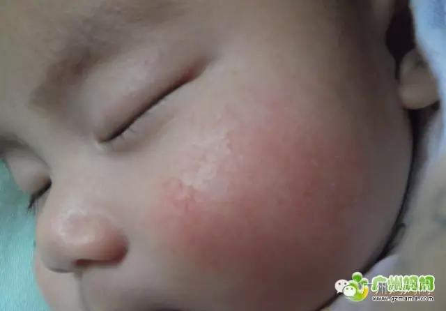 广州皮肤湿疹专家,湿疹皮肤干燥瘙痒挠出血