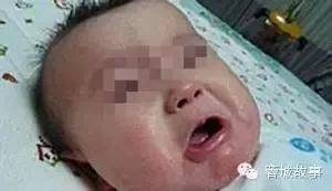 教你对付湿疹,别让湿疹误了宝宝颜值