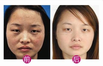 三招帮你远离雀斑的必杀技,对于雀斑应该如何有效的护理