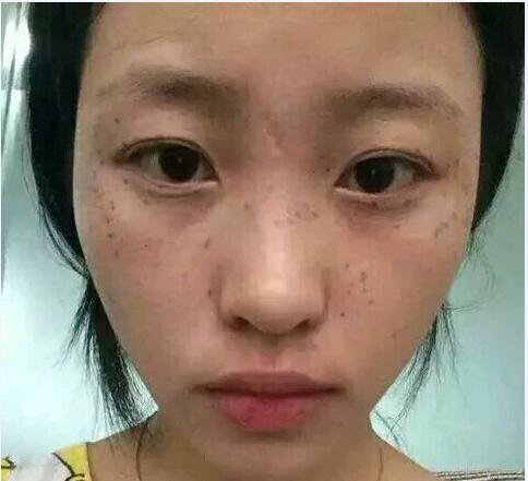 淡化斑点的方案,怎样抑制或淡化斑点