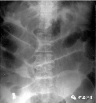 肠梗阻需要解决疑难护理问题,肠梗阻是大肠还是小肠问题