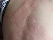 身上长了疹子特别痒还传染怎么办,身上奇痒无比长风团