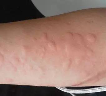 身上长了疹子特别痒还传染怎么办,身上奇痒无比长风团