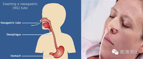 肠梗阻需要解决疑难护理问题,肠梗阻是大肠还是小肠问题