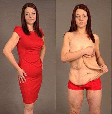 减肥后皮肤松驰多久才能恢复,减肥后皮肤松驰