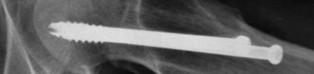 股骨颈骨折内固定钢钉要不要取,股骨颈骨折取钢钉休息多长时间