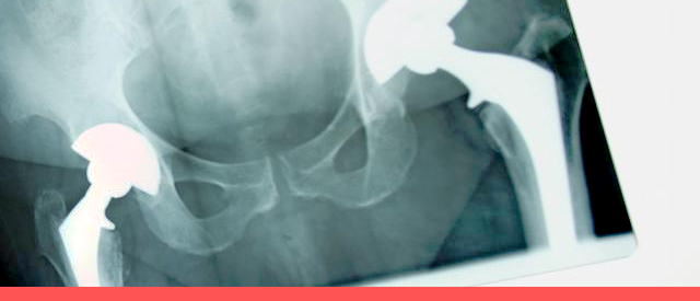 可善挺治疗强直性脊柱炎效果如何,治疗强直性脊柱炎的中成药有哪些