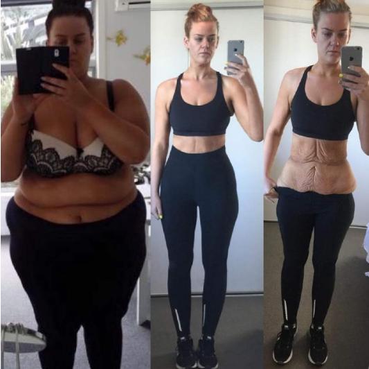 减肥后皮肤松驰多久才能恢复,减肥后皮肤松驰