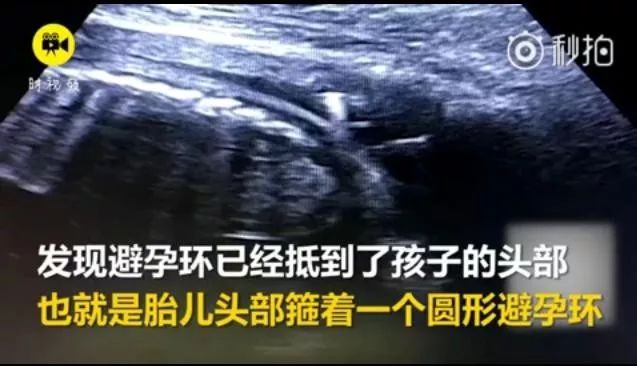 刚出生的婴儿顶着节育环,戴宫内节育器妊娠