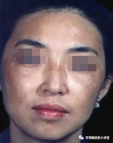 「杏林微科普」异斑异法早知道