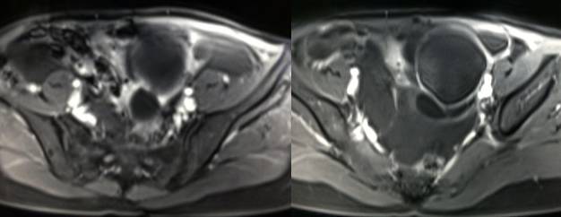 女性下腹疼痛是什么病,女性下腹疼痛的预兆