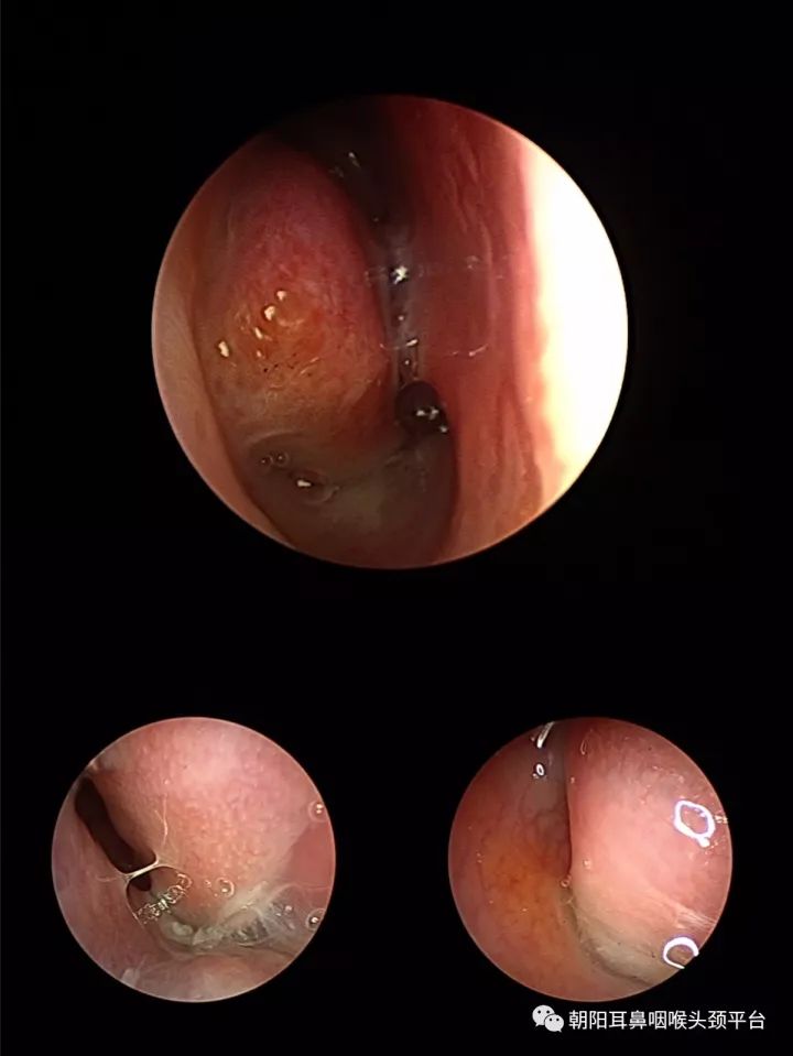 感冒了头疼什么原因,感冒了头疼怎么回事