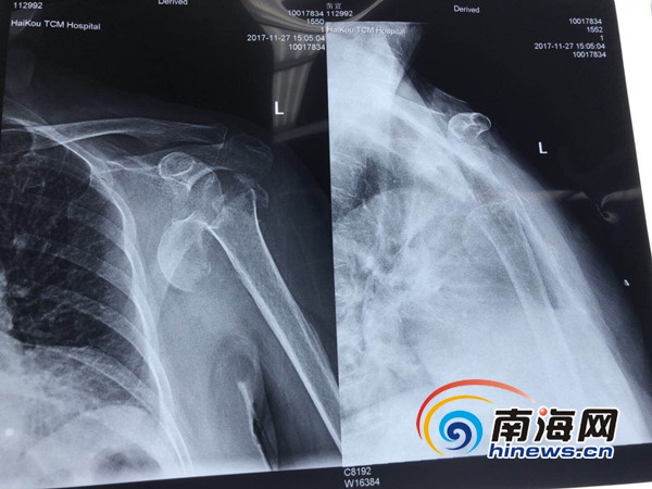 老人跌倒骨折微创手术康复,八旬老人腰椎骨折做微创手术