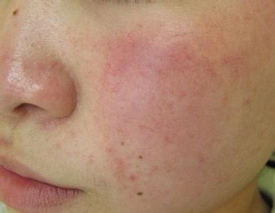 毛孔粗大做深层清洁能改善吗,毛孔粗大深层清洁用什么牌子面膜