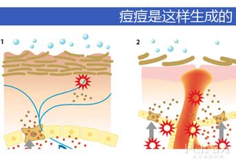 长痘的人到底有多惨如何正确祛痘,祛痘痘最好最实际的方法