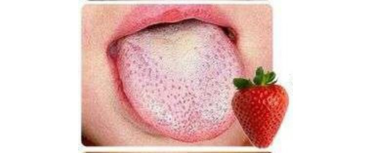 猩红热夏季,猩红热要保暖吗