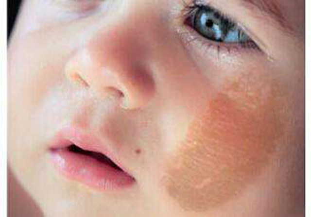 新生儿胎记判断,新生儿胎记种类都有哪些