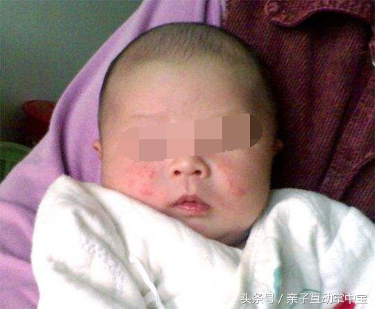 宝妈用母乳敷脸,宝宝脸上有湿疹为什么用母乳擦拭