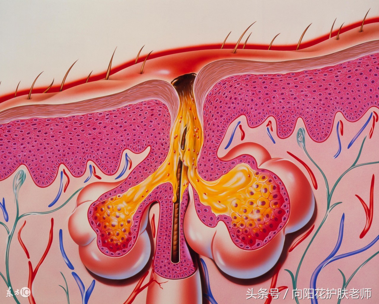 护理黑头的正确方法,挤黑头粉刺闭口如何护理