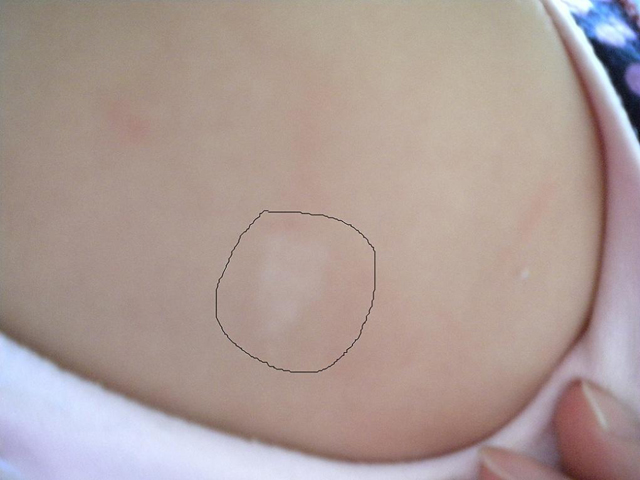 新生儿胎记判断,新生儿胎记种类都有哪些