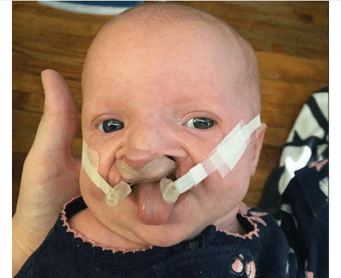 怀孕5个月了查出宝宝兔唇,孕妈没有按时产检娃有兔唇