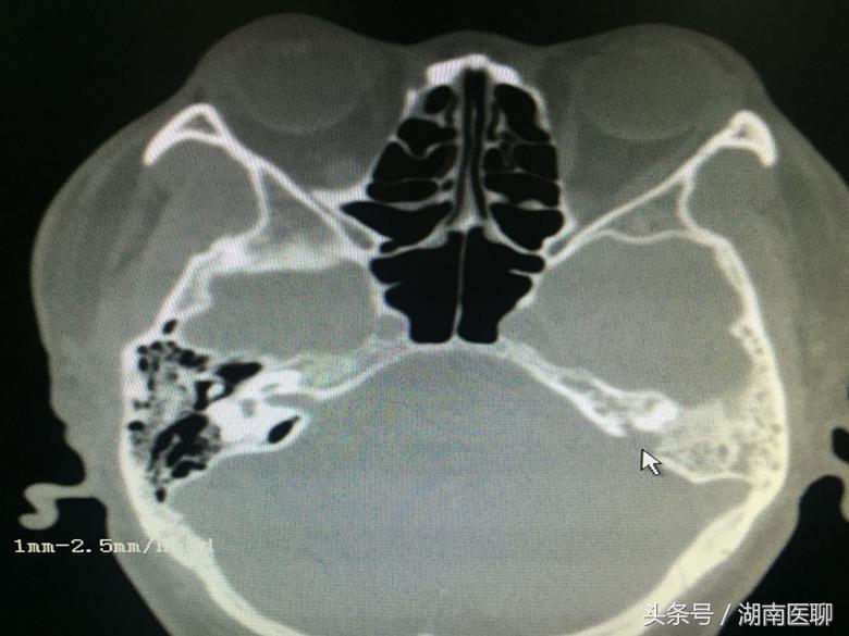脑膜穿孔引起流鼻涕吗,男子一直流鼻涕结果发现是脑脊液