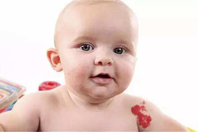 新生儿胎记判断,新生儿胎记种类都有哪些