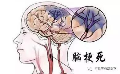 脑梗塞脑出血和中风有什么区别,脑出血脑梗塞脑血栓的区别表格