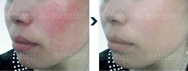 双玻嫩肤抗衰老效果,双波嫩肤