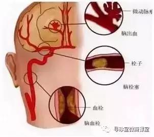 脑梗塞脑出血和中风有什么区别,脑出血脑梗塞脑血栓的区别表格